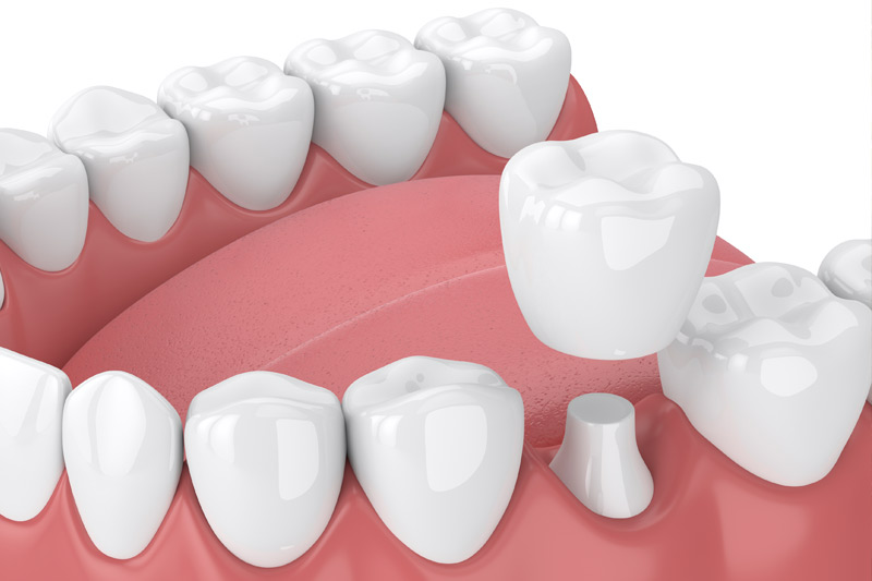 Dental Crowns in Reno