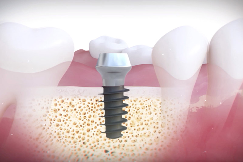 Minimally Invasive Dental Implants in Reno