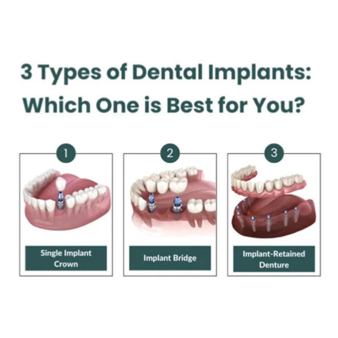 Dental Implants