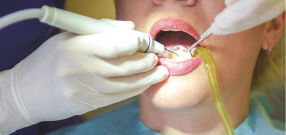 Gum Infection Therapy - Scaling and Root Planing