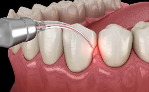 Laser Periodontal Therapy