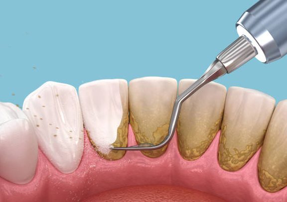 periodical care service futch dental
